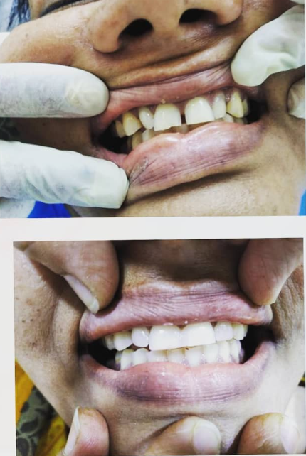 Before and after: Full-arch veneers at Dentcraft