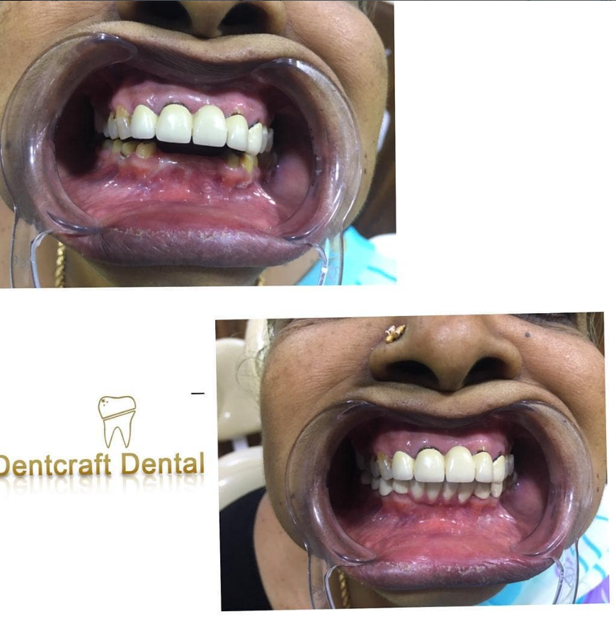 Before and after: Smile makeover at Dentcraft
