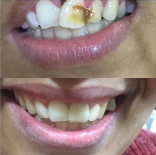 Before and after: Cosmetic bonding at Dentcraft